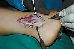 Illustration of inferior extensor retinaculum - Dr. Mohammed Hutaif