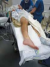 استخدام المبرد العظمي