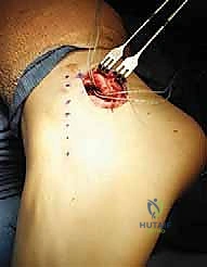 التأكد من جاهزية العظم