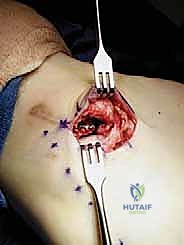 إدخال الخطاف الجراحي الأول