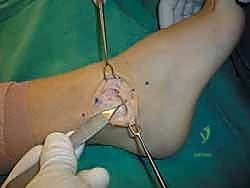 تقييم درجة الألم والتورم