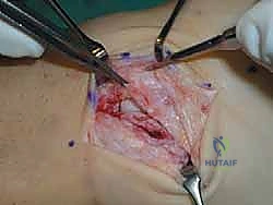 التحقق من التوتر الجيد للرباط