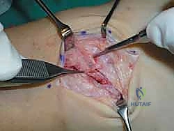 صورة طبية: إتقان إصلاح أربطة الكاحل الجانبية: دليل شامل لعملية بروسترم المعدلة مع الأستاذ الدكتور محمد هطيف