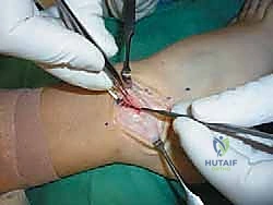 توضيح لخيارات العلاج