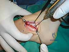 تحديد موقع الكبسولة المفصلية