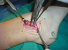 فحص مرونة الأربطة