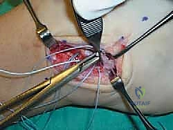 عقد الخيوط الجراحية بمهارة