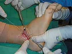 صورة توضيحية لـ إتقان إصلاح أربطة الكاحل الجانبية: دليل شامل لعملية بروسترم المعدلة مع الأستاذ الدكتور محمد هطيف