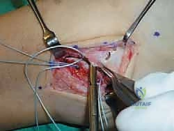 تعقيم وتخطيط منطقة الجراحة