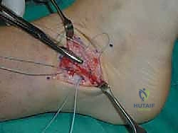 صورة طبية: إتقان إصلاح أربطة الكاحل الجانبية: دليل شامل لعملية بروسترم المعدلة مع الأستاذ الدكتور محمد هطيف