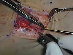 صورة طبية: إتقان إصلاح أربطة الكاحل الجانبية: دليل شامل لعملية بروسترم المعدلة مع الأستاذ الدكتور محمد هطيف