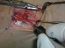 صورة طبية: إتقان إصلاح أربطة الكاحل الجانبية: دليل شامل لعملية بروسترم المعدلة مع الأستاذ الدكتور محمد هطيف