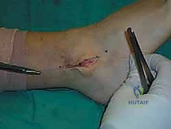 صورة طبية: إتقان إصلاح أربطة الكاحل الجانبية: دليل شامل لعملية بروسترم المعدلة مع الأستاذ الدكتور محمد هطيف