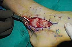 التحضير لقرار الجراحة