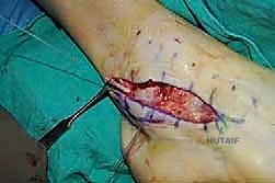 تمرير الخيوط عبر الرباط الممزق