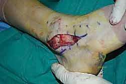 استخدام أدوات الخياطة الدقيقة