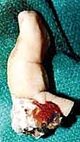 Intraoperative Surgical Step