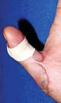 Intraoperative Surgical Step
