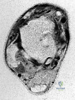 إعادة بناء أربطة الكاحل الجانبية: تقنية بروسترم غولد المعدلة لعلاج عدم الاستقرار المزمن مع الأستاذ الدكتور محمد هطيف