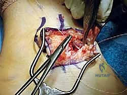 صورة توضيحية لـ إعادة بناء أربطة الكاحل الجانبية: تقنية بروسترم غولد المعدلة لعلاج عدم الاستقرار المزمن مع الأستاذ الدكتور محمد هطيف