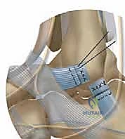 الخيارات العلاجية لالتواءات الكاحل المتكررة