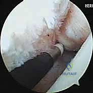 صورة توضيحية لـ إعادة بناء أربطة الكاحل الجانبية: تقنية بروسترم غولد المعدلة لعلاج عدم الاستقرار المزمن مع الأستاذ الدكتور محمد هطيف