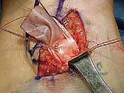 صورة توضيحية لـ إعادة بناء أربطة الكاحل الجانبية: تقنية بروسترم غولد المعدلة لعلاج عدم الاستقرار المزمن مع الأستاذ الدكتور محمد هطيف