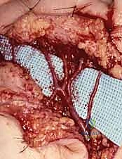 إعادة توعية اليد: دليل شامل لعلاج متلازمة رينود والانسدادات الوعائية في صنعاء مع الأستاذ الدكتور محمد هطيف