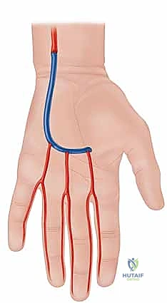 صورة توضيحية لـ إعادة توعية اليد: دليل شامل لعلاج متلازمة رينود والانسدادات الوعائية في صنعاء مع الأستاذ الدكتور محمد هطيف