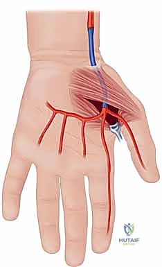 Illustration of radial and ulnar - Dr. Mohammed Hutaif