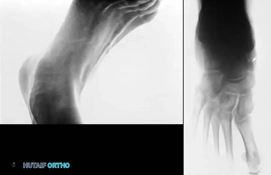 ACCESSORY NAVICULAR Surgical Diagram