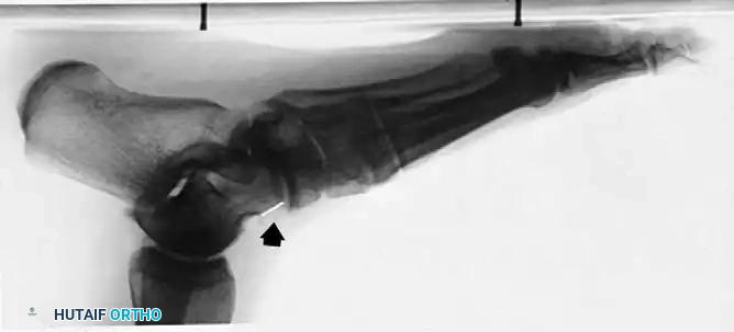 ACCESSORY NAVICULAR Surgical Diagram