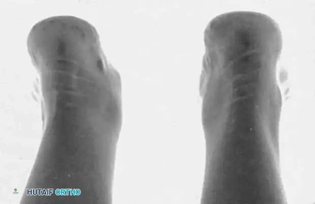 ACCESSORY NAVICULAR Surgical Diagram