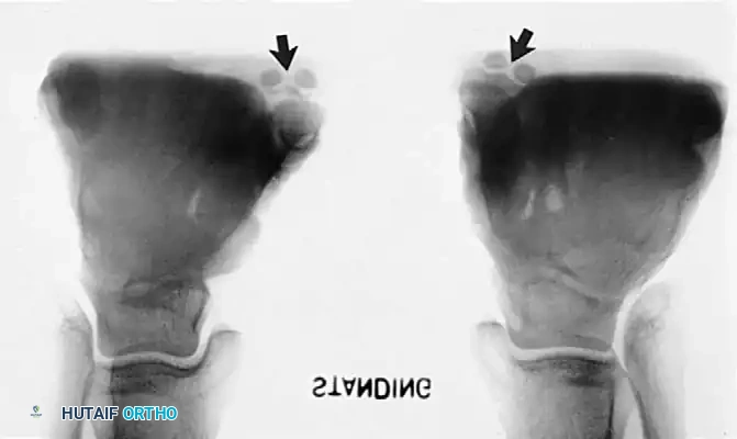 Fig. 79-9 A, Note bilateral accessory navicular. Left, ossicle displaced after trauma.