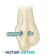 ACHILLES TENDON AUGMENTATION OF SUPERIOR PERONEAL RETINACULUM REPAIR Surgical Diagram