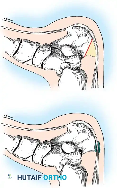 Achilles Tendon Disorders: Comprehensive Surgical Management