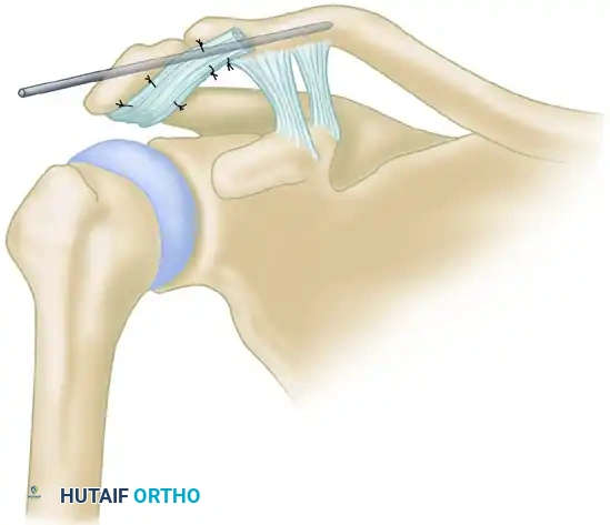ACROMIOCLAVICULAR JOINT Surgical Diagram