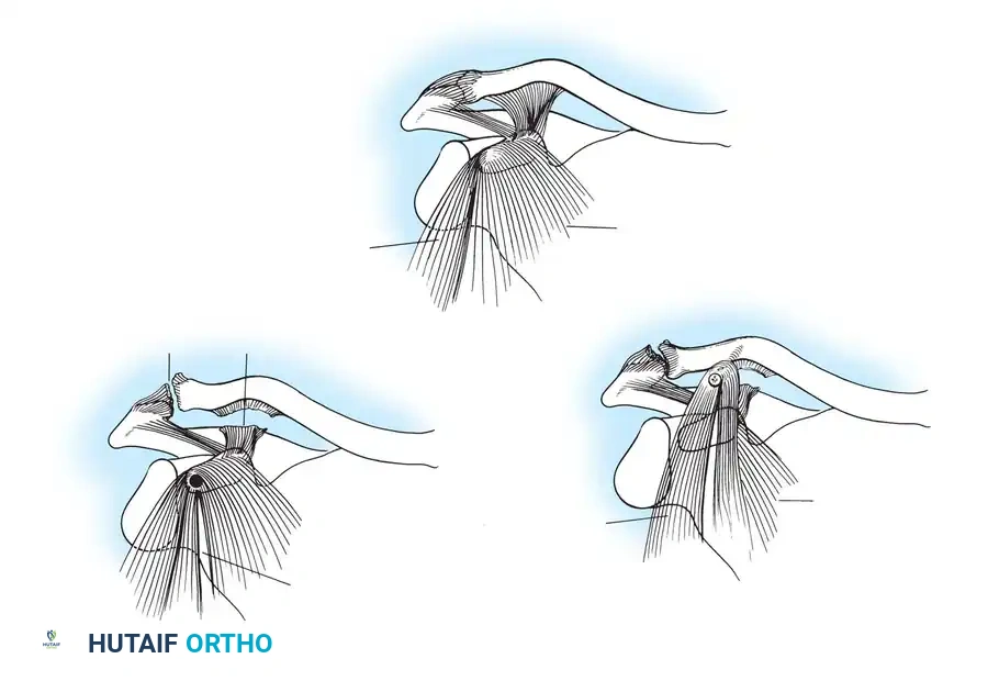 Dewar and Barrington technique for repairing old dislocations of acromioclavicular joint