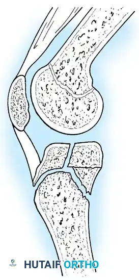 Fig. 33-177 Sagittal view of knee depicting epiphyseal fracture pattern...