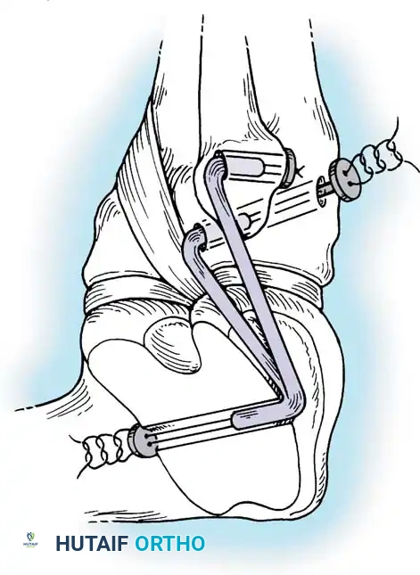 Hutaifortho's Orthopaedic Diagram