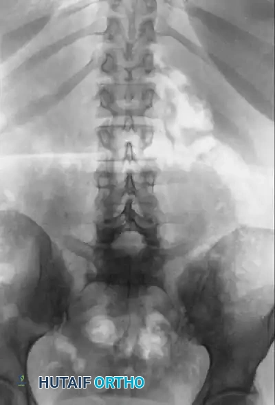 ADULT ISTHMIC SPONDYLOLISTHESIS Surgical Diagram