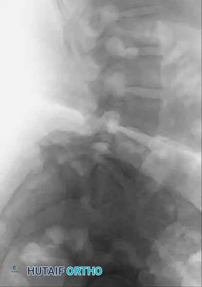 Fig. 41-16 Standing anteroposterior (A) and lateral (B) radiographs of patient with isthmic spondylolisthesis.