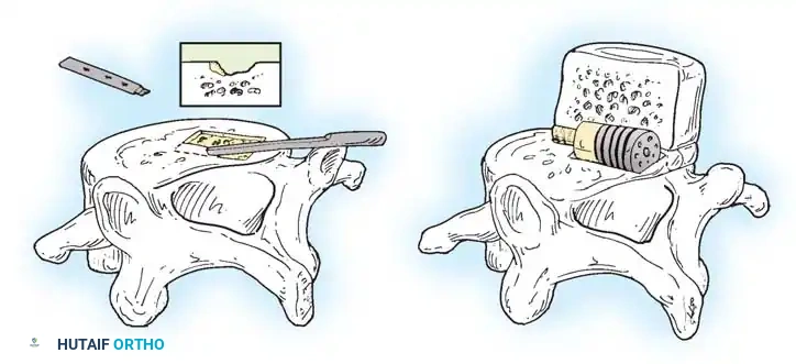 Surgical Diagram - Anterior Approach
