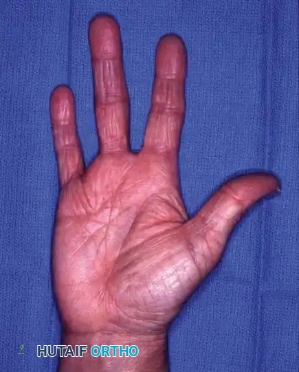 دليل شامل حول بتر الأصابع الفردية واستئصال الشعاع الجراحي