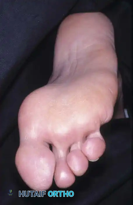 Clinical photo fifth toes B