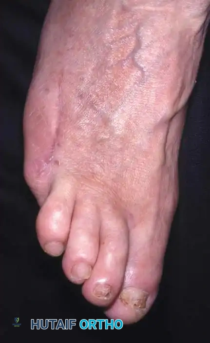 Clinical photo fifth toes A