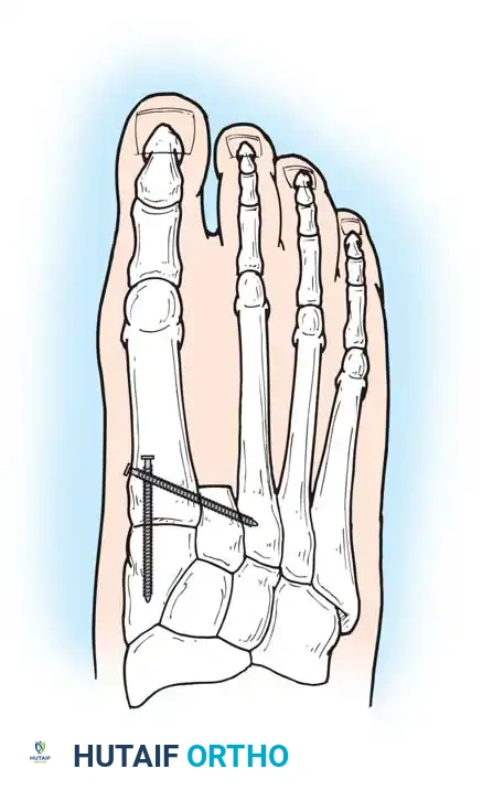Second ray amputation with screw fixation