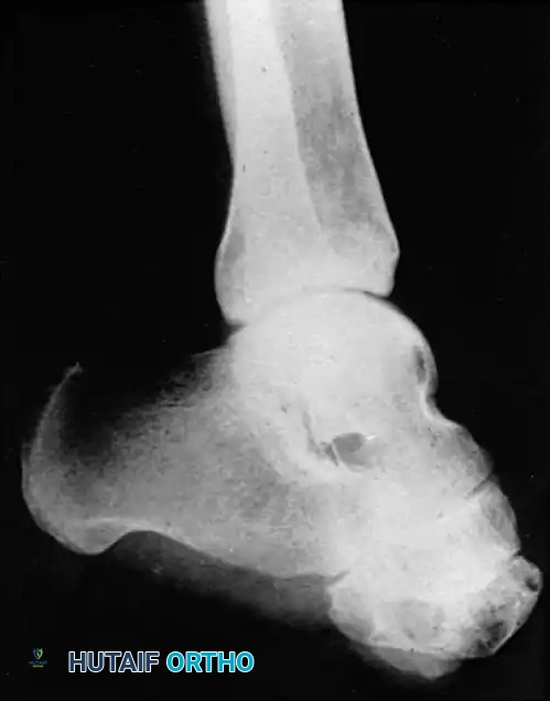 Severe equinus deformity