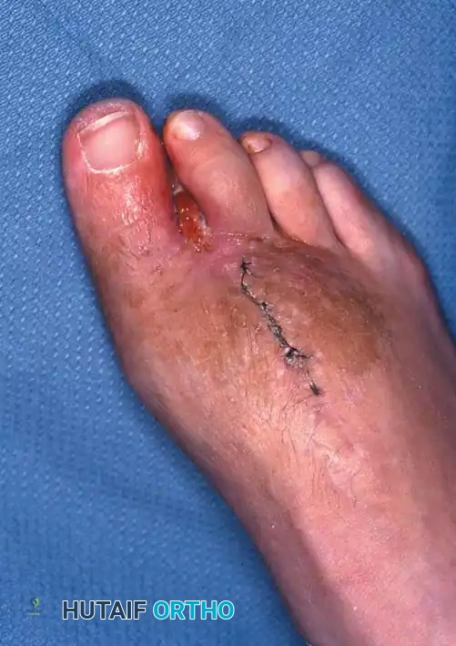 Amputation of second digit