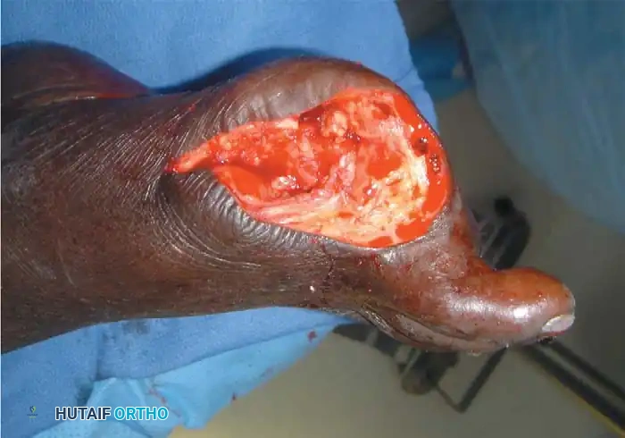 Excision
Associated Surgical & Radiographic Imaging
![Hutaifortho's Orthopaedic Diagram